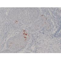 Mammaglobin A+B Monoclonal Antibody PT0163