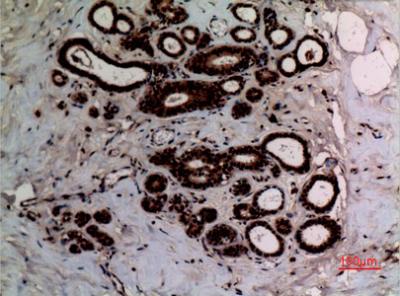  Immunohistochemical analysis of paraffin-embedded human-breast, antibody was diluted at 1:100