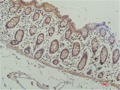  Immunohistochemical analysis of paraffin-embedded Human Colon Carcinoma Tissue using HADC1 Mouse mAb diluted at 1:200.