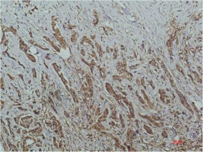  Immunohistochemical analysis of paraffin-embedded Human Breast Carcinoma Tissue using HADC1 Mouse mAb diluted at 1:200.
