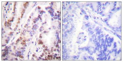  Immunohistochemistry analysis of paraffin-embedded human lung carcinoma tissue, using HDAC9 Antibody. The picture on the right is blocked with the synthesized peptide.