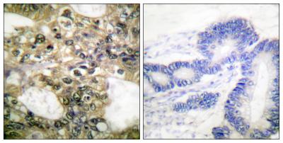  Immunohistochemistry analysis of paraffin-embedded human colon carcinoma tissue, using HDAC6 Antibody. The picture on the right is blocked with the synthesized peptide.
