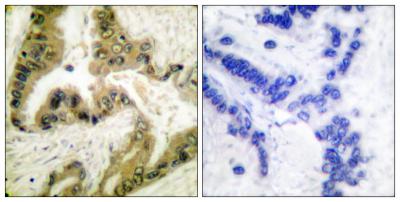  Immunohistochemistry analysis of paraffin-embedded human lung carcinoma tissue, using HDAC10 Antibody. The picture on the right is blocked with the synthesized peptide.