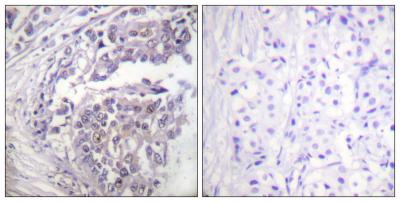  Immunohistochemistry analysis of paraffin-embedded human breast carcinoma tissue, using Histone H2B (Acetyl-Lys5) Antibody. The picture on the right is blocked with the synthesized peptide.