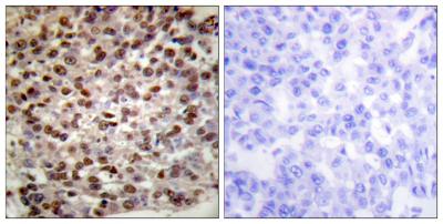  Immunohistochemistry analysis of paraffin-embedded human breast carcinoma tissue, using Histone H2B (Acetyl-Lys15) Antibody. The picture on the right is blocked with the synthesized peptide.
