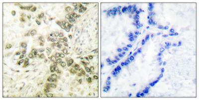  Immunohistochemical analysis of paraffin-embedded Human lung cancer. Antibody was diluted at 1:100(4°,overnight). High-pressure and temperature Tris-EDTA,pH8.0 was used for antigen retrieval. Negetive contrl (right) obtaned from antibody was pre-absorbed by immunogen peptide.