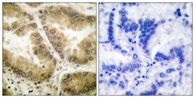  Immunohistochemistry analysis of paraffin-embedded human lung carcinoma tissue, using HDAC7 Antibody. The picture on the right is blocked with the synthesized peptide.