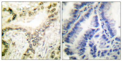  Immunohistochemistry analysis of paraffin-embedded human lung carcinoma tissue, using Histone H3 (Acetyl-Lys18) Antibody. The picture on the right is blocked with the synthesized peptide.