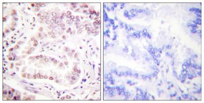  Immunohistochemistry analysis of paraffin-embedded human lung carcinoma tissue, using Histone H3 (Acetyl-Lys27) Antibody. The picture on the right is blocked with the synthesized peptide.