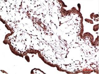  Immunohistochemical analysis of paraffin-embedded Human Colon Carcinoma Tissue using HP-1γ Mouse mAb diluted at 1:200