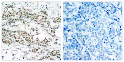  Immunohistochemistry analysis of paraffin-embedded human breast carcinoma, using AFX (Phospho-Ser197) Antibody. The picture on the right is blocked with the phospho peptide.