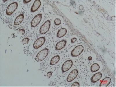  Immunohistochemical analysis of paraffin-embedded Human Colon Caricnoma using HSP90 α Mouse mAb diluted at 1:200.
