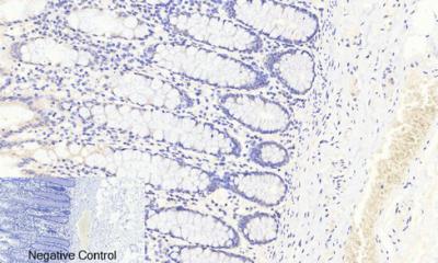  Immunohistochemical analysis of paraffin-embedded Human-colon tissue. 1,FoxO3A (phospho Ser253) Polyclonal Antibody was diluted at 1:200(4°C,overnight). 2, Sodium citrate pH 6.0 was used for antibody retrieval(>98°C,20min). 3,Secondary antibody was diluted at 1:200(room tempeRature, 30min). Negative control was used by secondary antibody only.