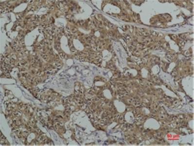  Immunohistochemical analysis of paraffin-embedded Human Breast Caricnoma using HSC70 Mouse mAb diluted at 1:200.