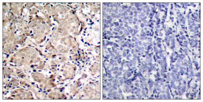  Immunohistochemistry analysis of paraffin-embedded human breast carcinoma, using FKHR (Phospho-Ser319) Antibody. The picture on the right is blocked with the phospho peptide.