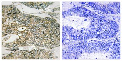  Immunohistochemistry analysis of paraffin-embedded human colon carcinoma, using GRB2 (Phospho-Ser159) Antibody. The picture on the right is blocked with the phospho peptide.