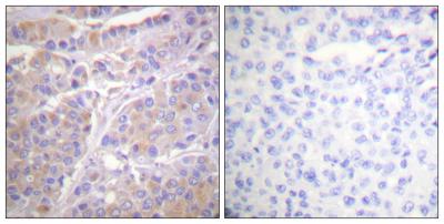  Immunohistochemistry analysis of paraffin-embedded human breast cancer, using GAB1 (Phospho-Tyr659) Antibody. The picture on the right is blocked with the GAB1 (Phospho-Tyr659) peptide.